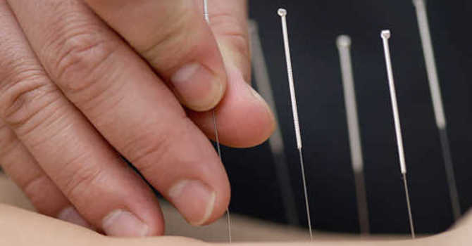 Acupuncture vs ______? image