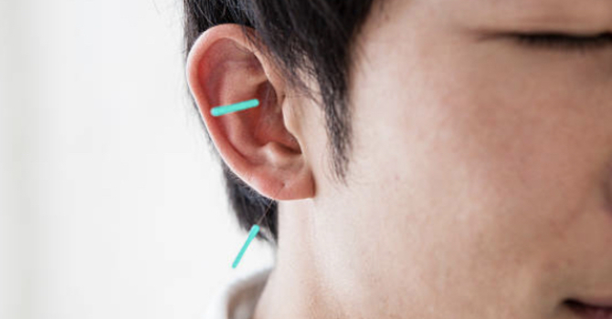 Available in August at OSCA:  Student auricular acupuncture clinic!